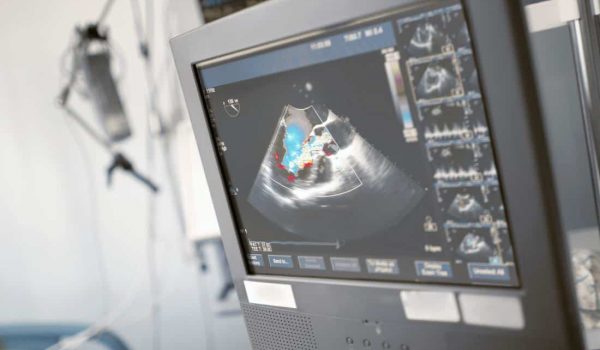 a-screen-showing-an-echocardiogram a-screen-showing-an-echocardiogram