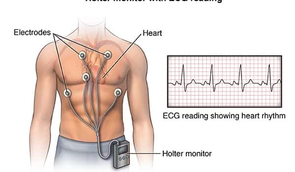 Front view male figure torso with holter monitor and ekg/heart rhythm inset Anterior view male figure torso with holter monitor and ekg/heart rhythm inset; ACardio_20140402_v0_005SOURCE: cardio_holter-monitor_proc_1_layers.psd